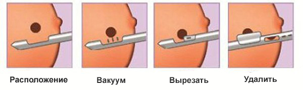 Вакуумная аспирационная биопсия молочной железы Улан-Удэ